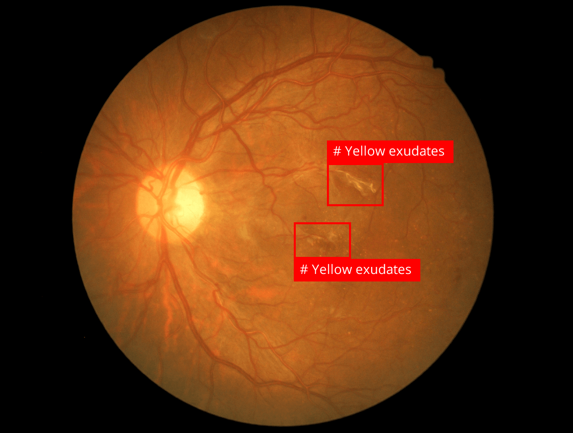 Computer vision detection example
